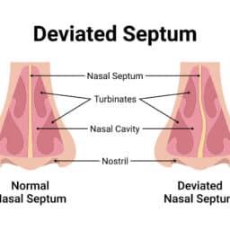 A diagram on the structure of the nose and what a deviated septum is.